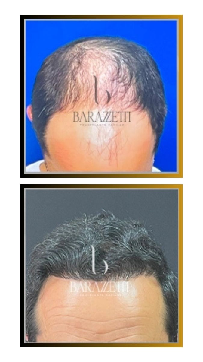 Antes e depois