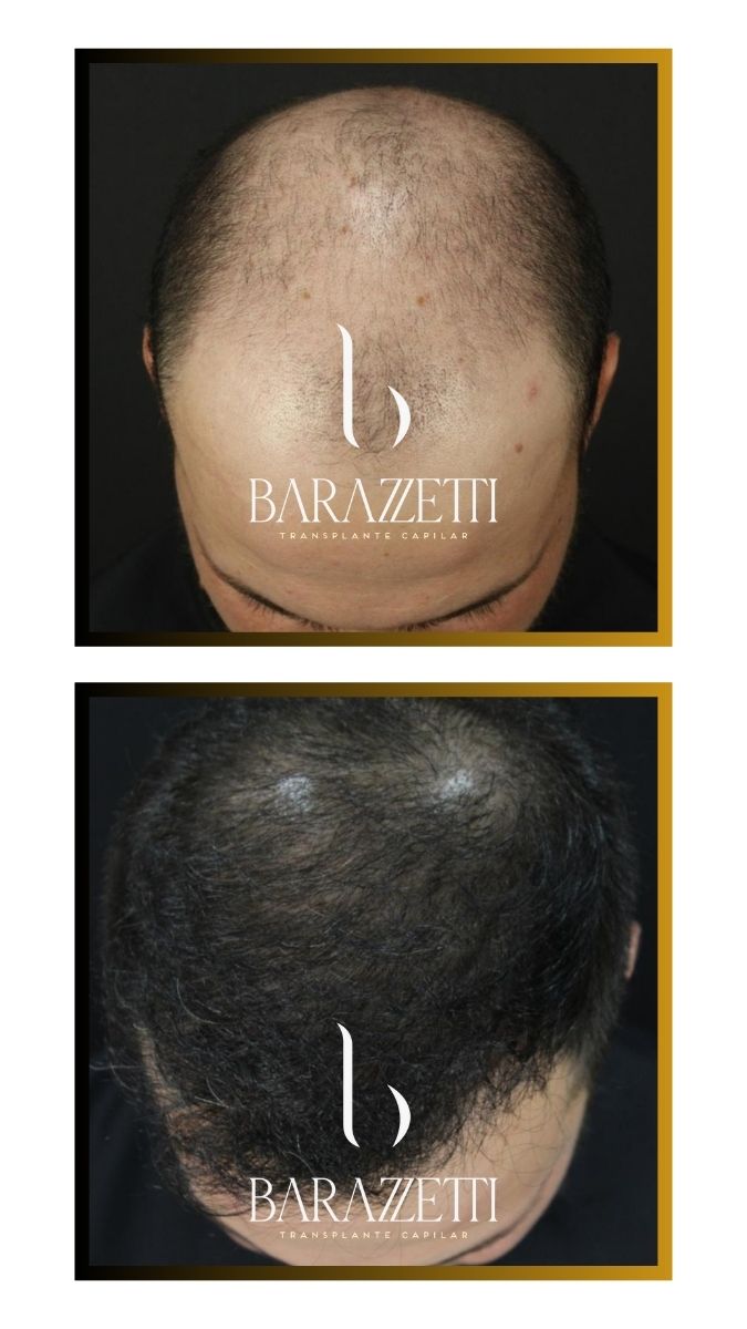 Antes e depois