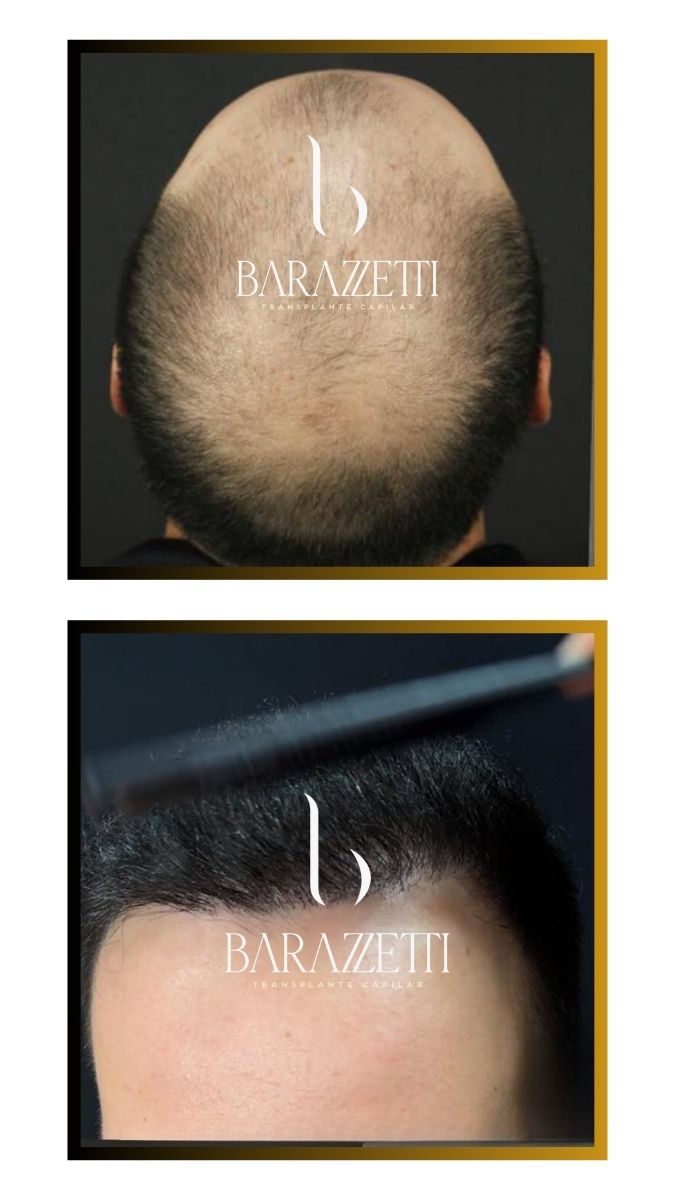 Antes e depois