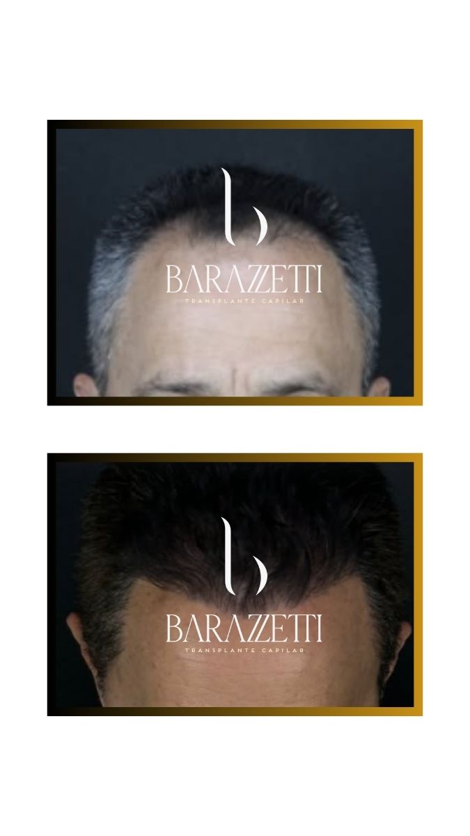 Antes e depois