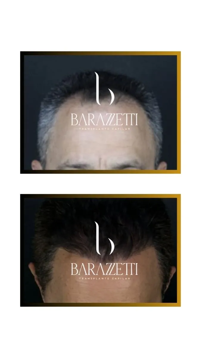 Antes e depois